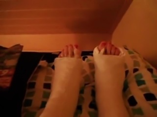 wiggling toes sticking out of two fresh plaster casts